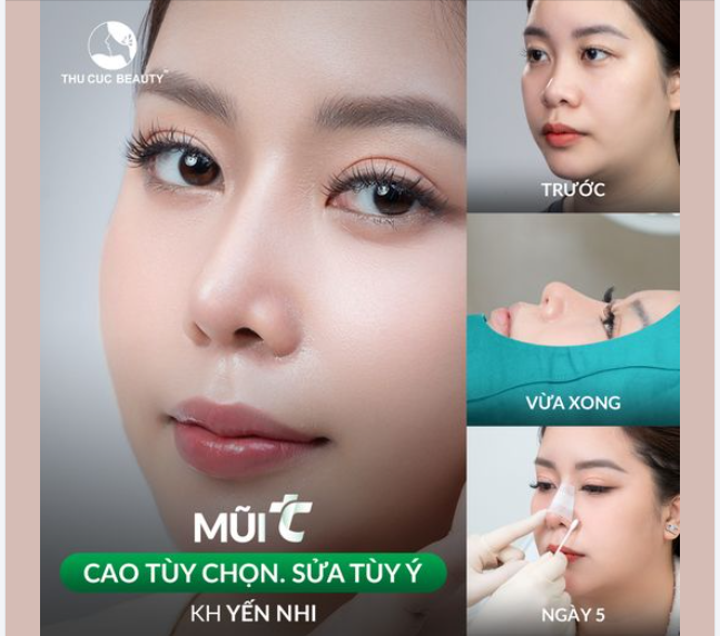 Tạm biệt chiếc mũi thấp tẹt "phong ấn" nhan sắc của bạn
