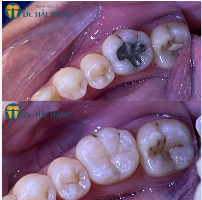 TRÁM RĂNG SÂU CÓ BỊ ĐAU KHÔNG ?