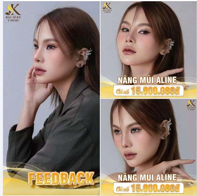 TẠI SAO CỨ 10 NGƯỜI THÌ CÓ ĐẾN 10 NGƯỜI MUỐN NÂNG MŨI TẠI BÁC SĨ KỲ Y DƯỢC?