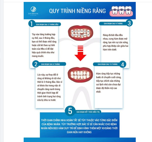 QUY TRÌNH NIỀNG RĂNG