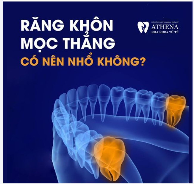 Răng khôn mọc thẳng có nên nhổ không?