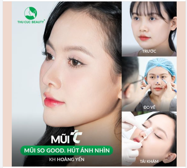 Nâng tầm nhan sắc khi loại bỏ chiếc mũi thấp tẹt
