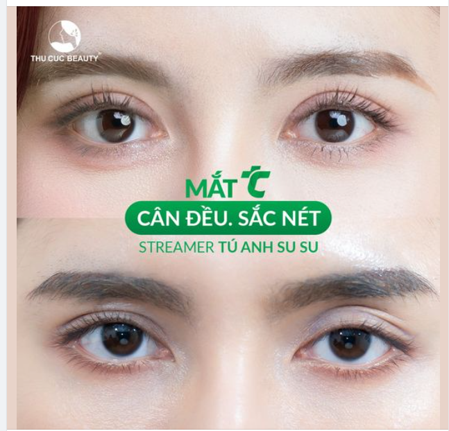 Đến TC để tạm biệt đôi mắt đa nếp mí