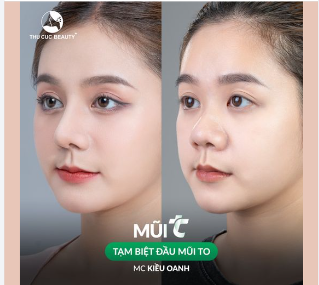 Say "bye" đầu mũi to làm gương mặt kém sắc Chọn Mũi TC