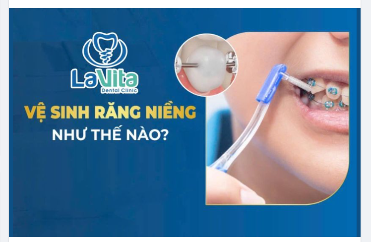 THẾ NÀO LÀ VỆ SINH ĐÚNG CÁCH KHI NIỀNG RĂNG MẮC CÀI?