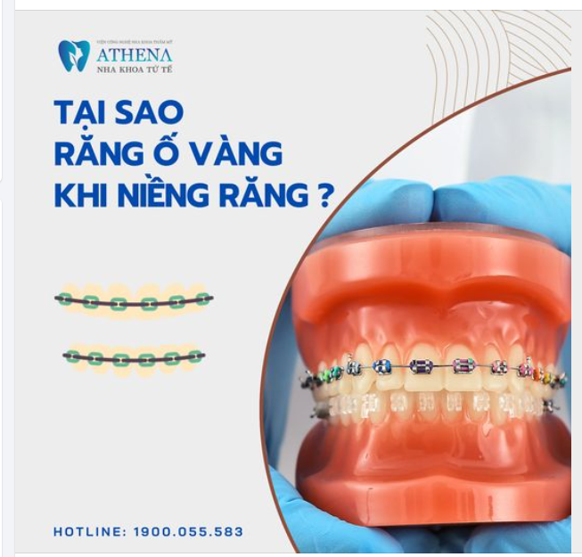 Tại sao răng ố vàng khi niềng răng
