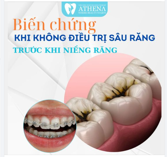 Niềng răng là một phương pháp điều chỉnh vị trí răng để có một hàm răng đều đặn và nụ cười hoàn hảo hơn.