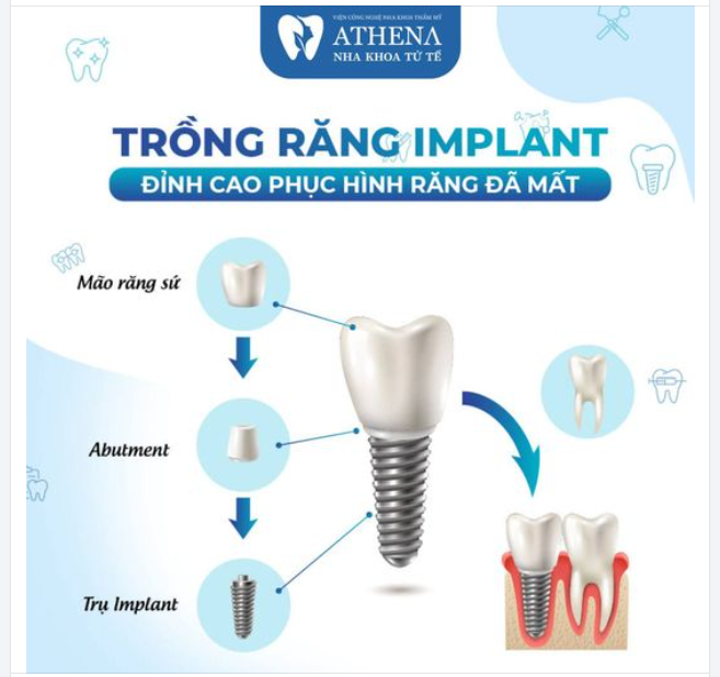 TRỒNG RĂNG IMPLANT - ĐỈNH CAO PHỤC HÌNH RĂNG ĐÃ MẤT