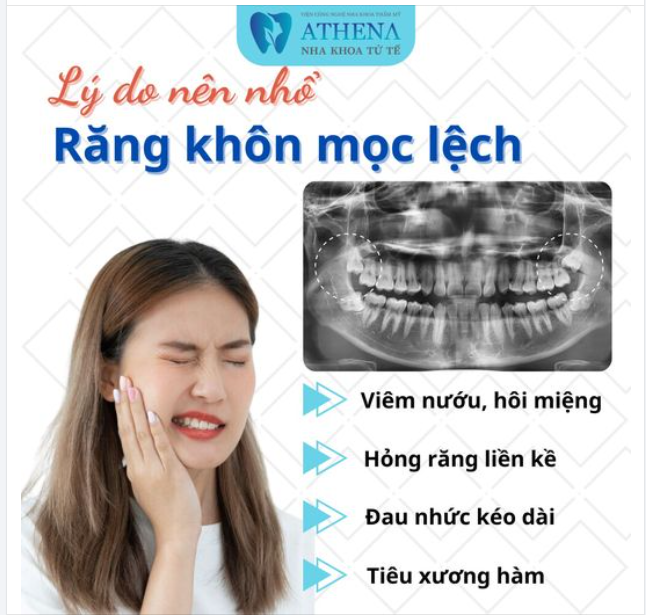 Răng khôn mọc lệch thường không tham gia vào chức năng ăn nhai mà còn gây ra nhiều tác hại cho khổ chủ.