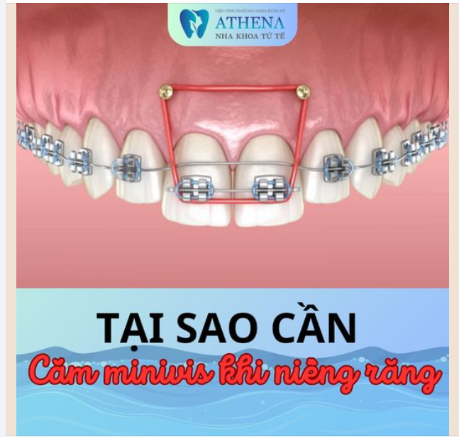 Tại sao cần Cắm Minivis khi niềng răng?