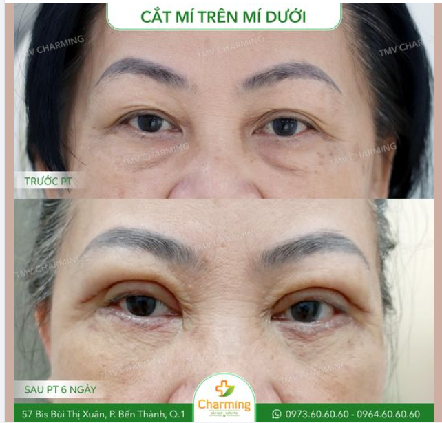 Trước khi phẫu thuật, cô khách gặp tình trạng mí mắt trên và mí dưới xuất hiện da chùng và bọng mắt, làm cho đôi mắt trông thiếu sức sống và gương mặt có phần già dặn hơn.