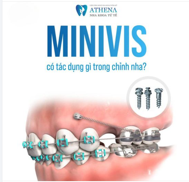 Minivis có tác dụng như thế nào trong chỉnh nha?