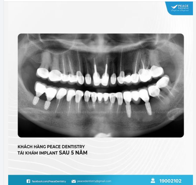TÁI KHÁM IMPLANT BỀN VỮNG SAU 5 NĂM MINH CHỨNG ĐIỀU GÌ?