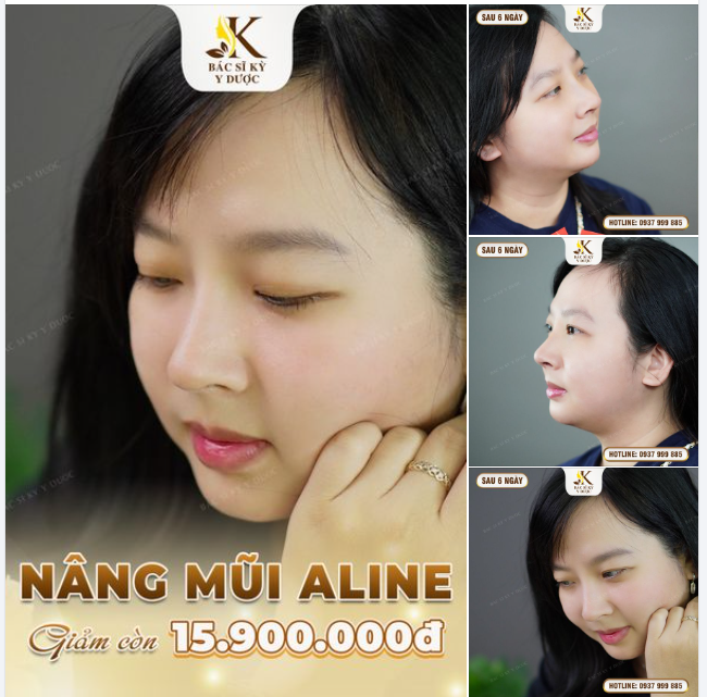 SO HOT - NÂNG MŨI ALINE CHỈ 15,9TR