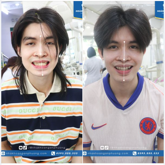 10 tháng niềng răng đã thay đổi Anh Tuấn như thế nào?