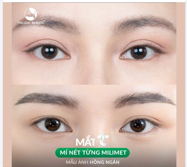 Chọn Mắt TC - 15P có ngay nếp mí cân đều, tự nhiên