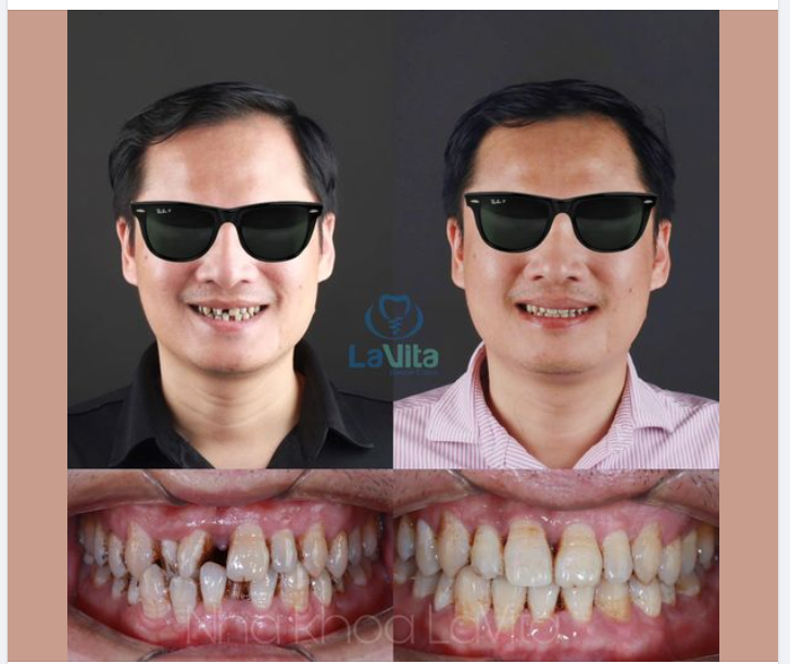NIỀNG RĂNG Ở TUỔI 40 LÀ CÂU CHUYỆN HOÀN TOÀN CÓ THỂ!