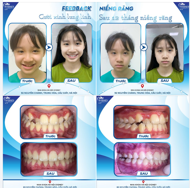 CƯỜI XINH LUNG LINH SAU 24 THÁNG ĐEO NIỀNG