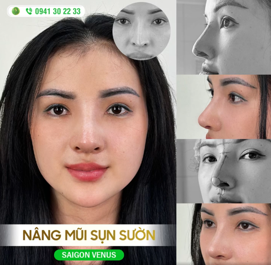 GIẢI CỨU MŨI HƯ - TÁI SINH NHAN SẮC CÙNG NÂNG MŨI SỤN SƯỜN