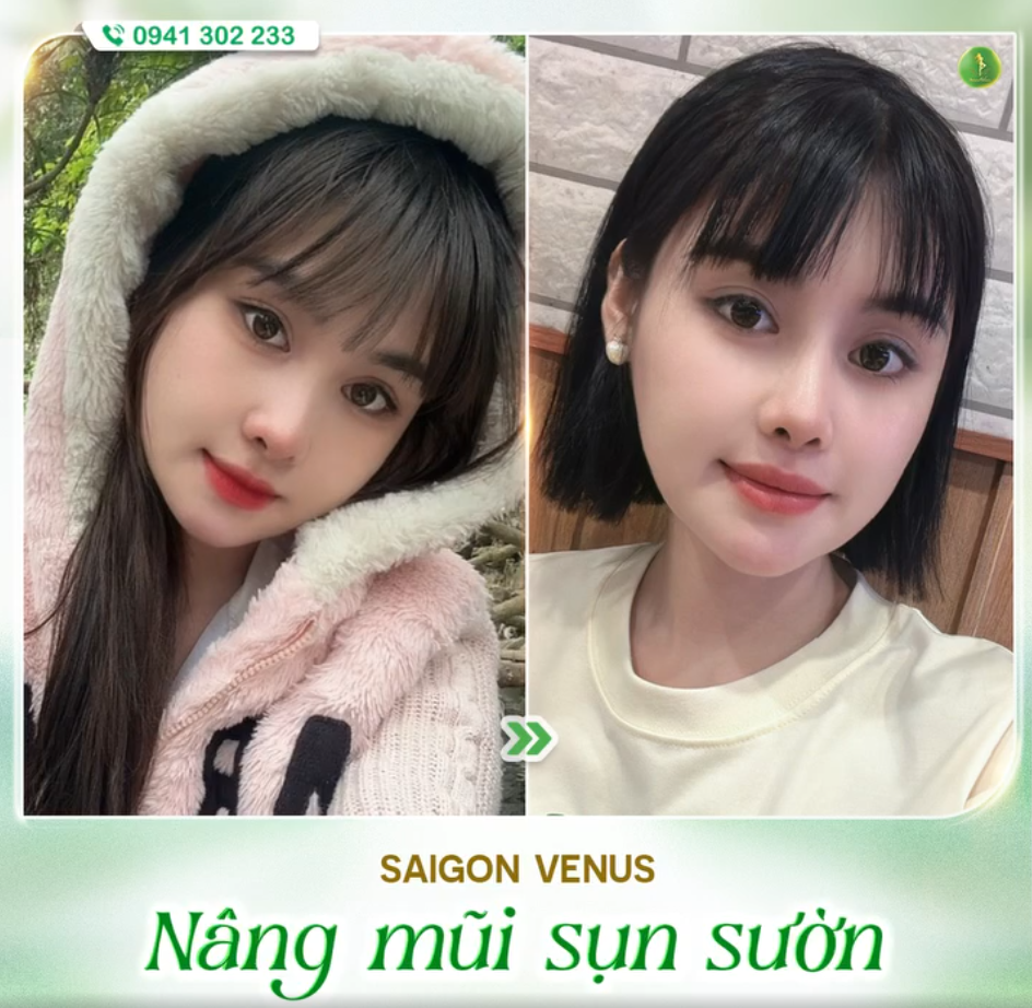 MŨI ĐẸP, BỀN NHỜ CÔNG NGHỆ SỤN SƯỜN FASCIA