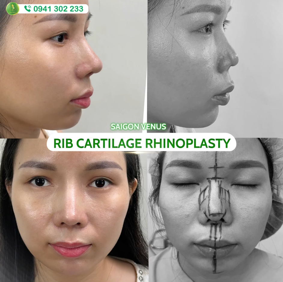 KHÁCH HÀNG THAY ĐỔI DIỆN MẠO NHỜ MŨI SỤN SƯỜN