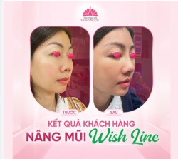 KHOE GÓC NGHIÊNG THẦN THÁNH SAU 7 NGÀY NÂNG MŨI WISH LINE