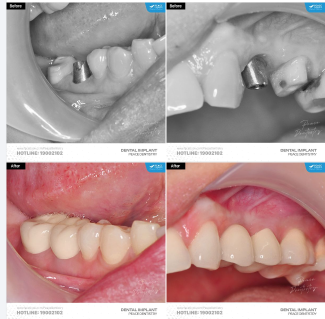 CA LÂM SÀNG IMPLANT: Phục hồi R46 và R24 với sự chỉn chu, tối ưu về thẩm mỹ, chức năng và độ vững ổn lâu dài cho khách hàng.