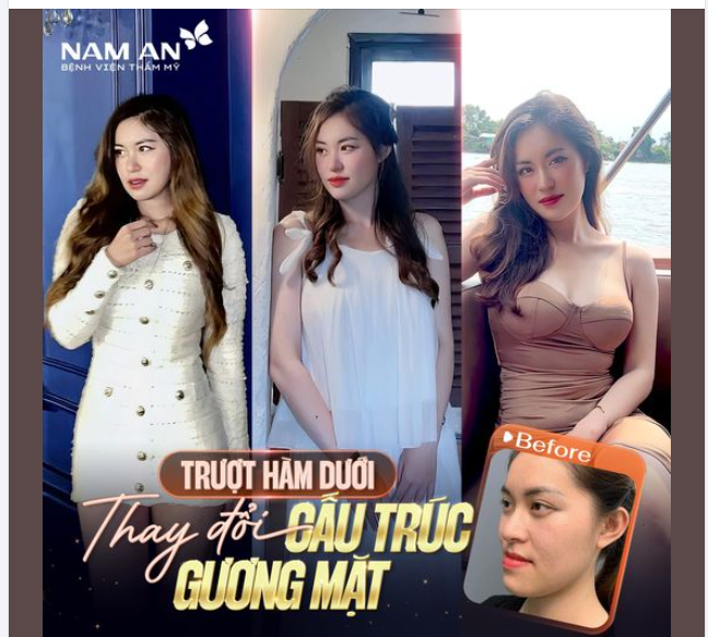 Biến đổi ngoạn mục sau khi trượt hàm dưới!