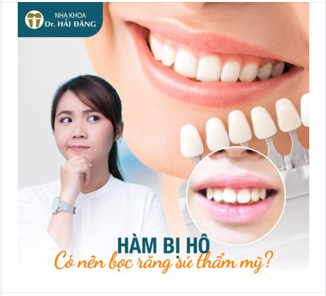 HÀM BỊ HÔ CÓ NÊN BỌC RĂNG SỨ THẨM MỸ KHÔNG