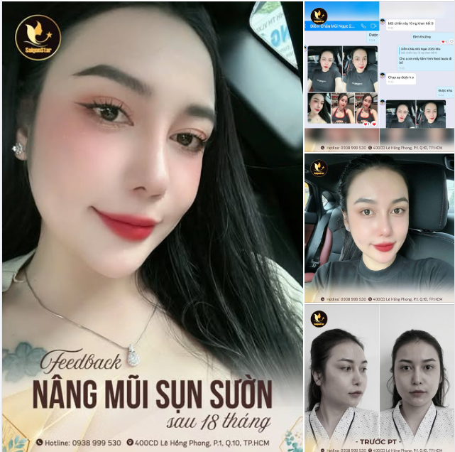 MŨI ĐẸP - FEEDBACK SIÊU XINH SAU 18 THÁNG SỬA LẠI MŨI HỎNG!!!