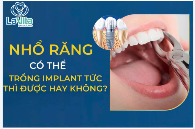 NHỔ RĂNG XONG CÓ THỂ CẮM IMPLANT TỨC THÌ ĐƯỢC KHÔNG?
