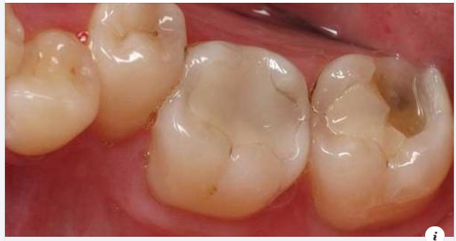Những vật liệu trám răng thông dụng