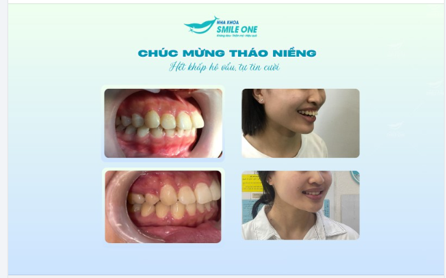 HỆ LỤY CỦA HÀM RĂNG HÔ MÀ BẠN NÊN BIẾT!