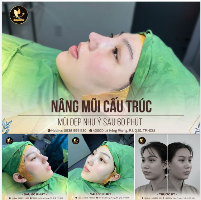 NÂNG MŨI CẤU TRÚC - GIẢI PHÁP TÁI TẠO DÁNG MŨI ĐẸP HOÀN HẢO SAU 60 PHÚT