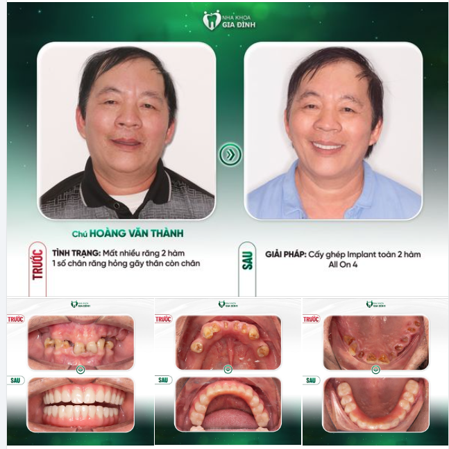 TRỒNG RĂNG TOÀN HÀM THỎA MÃN KỲ VỌNG ĂN NGON, SỐNG KHỎE CỦA NGƯỜI LỚN TUỔI