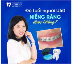 Độ tuổi ngoài 40 có nên niềng răng không?