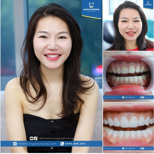 Tái khám dán sứ sau gần 2 năm thì sẽ như thế nào?