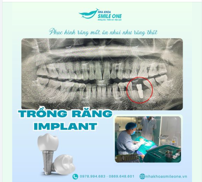 BẠN ĐANG KHỔ SỞ CHỊU ĐỰNG VÌ MẤT RĂNG?