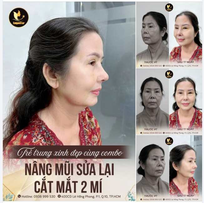 NÂNG MŨI VÀ CẮT MÍ CÙNG LÚC - CÔ KHÁCH U60 TRẺ HẲN 10 TUỔI