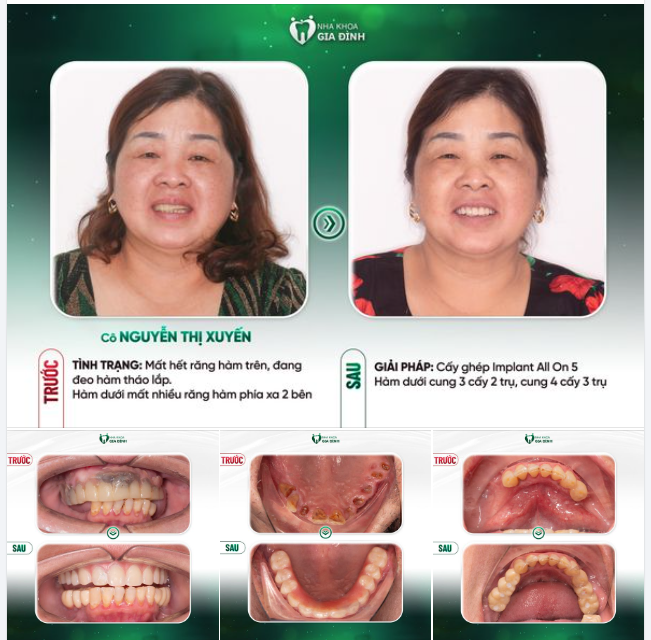 MỘT HÀM RĂNG KHỎE MẠNH - MÓN QUÀ VÔ GIÁ GỬI TẶNG NGƯỜI THÂN