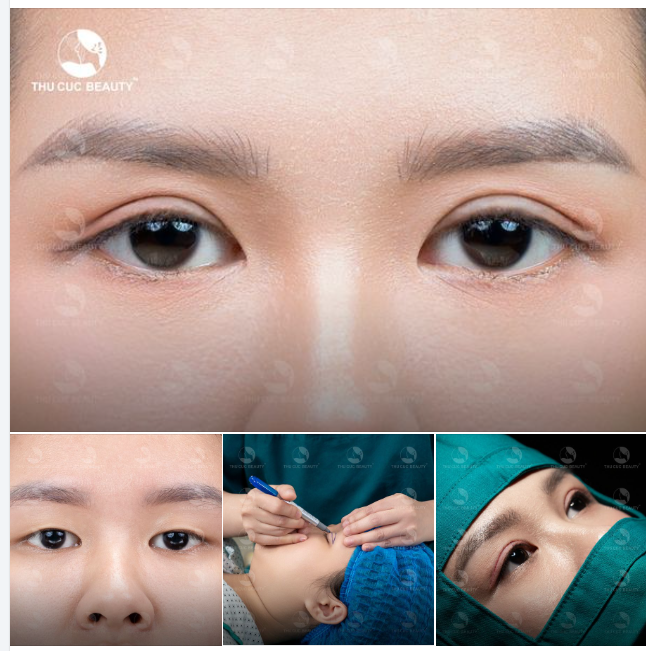 Đẹp ngay tức thì khi cắt mí tại TC