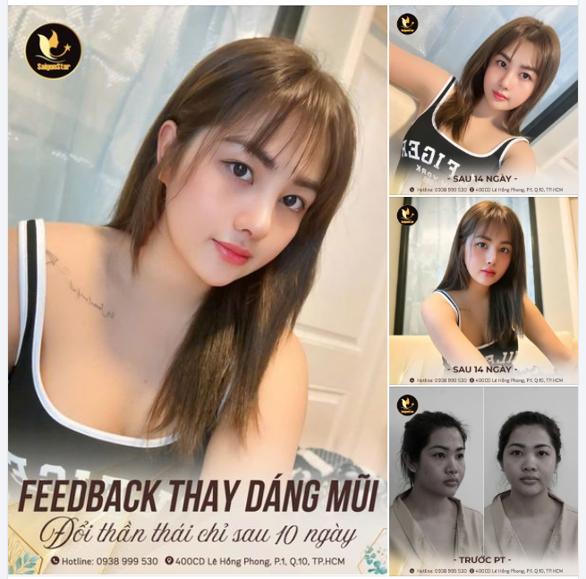 Một chiếc feedback ngập tràn động lực cho chị em đi nâng mũi - Thay đổi diện mạo kịp chào đón mùa lễ hội cuối năm rồi đây!!!