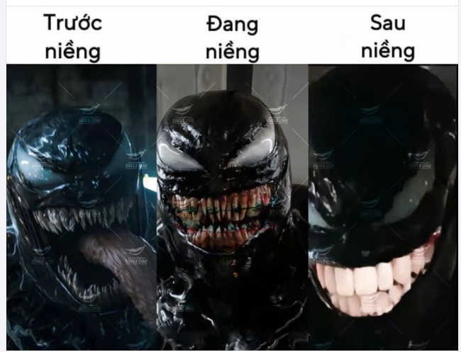 Trước và sau khi niềng của anh ấy!