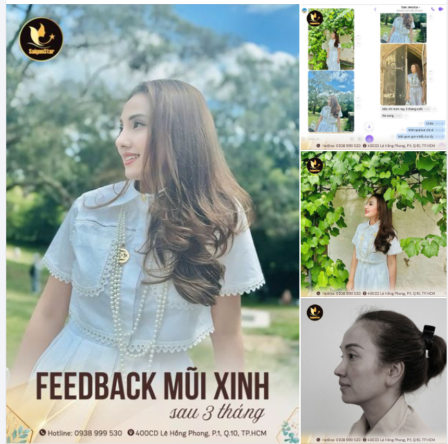 Feedback mũi đẹp nhà Bác sĩ Hoạt đây ạ!!!