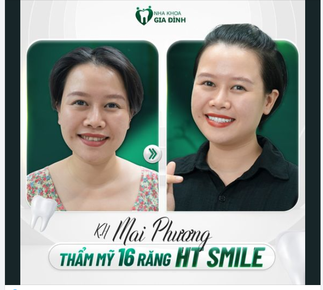 NÂNG CẤP NỤ CƯỜI - THÊM PHẦN ẤN TƯỢNG