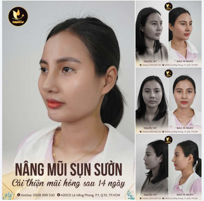 SỬA LẠI MŨI HỎNG - CAO ĐẸP NHƯ Ý SAU 14 NGÀY