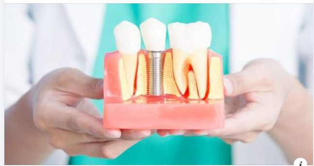 9 lợi ích của việc cấy ghép Implant