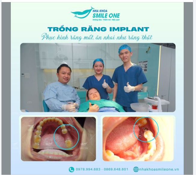 PHỤC HÌNH RĂNG MẤT, ĂN NHAI NHƯ RĂNG THẬT
