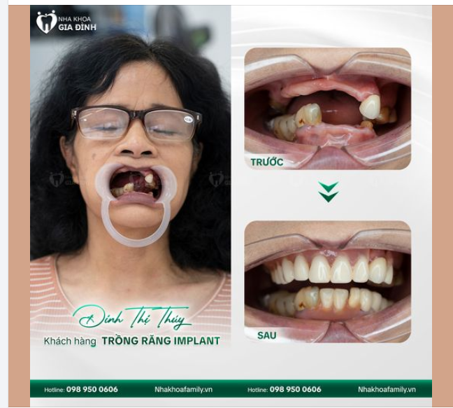 "IMPLANT ALL ON 4 - GIẢI PHÁP PHỤC HÌNH RĂNG TOÀN HÀM TỐI ƯU NHẤT HIỆN NAY