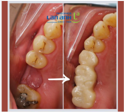 Làm thế nào để tránh cho cầu răng bị bể vỡ khi ăn nhai?